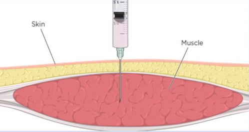 Site d injection intra musculaire 3