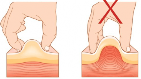 Site d injection sous cutanée