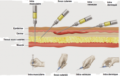 Tpe d injection min